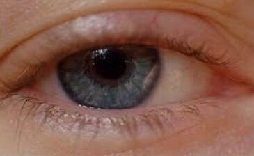 Blepharitis mit Oculax geheilt